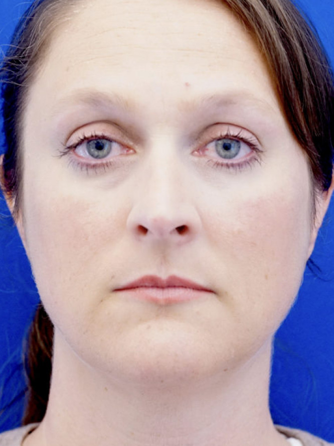 Nasal Profile Femininity — Before