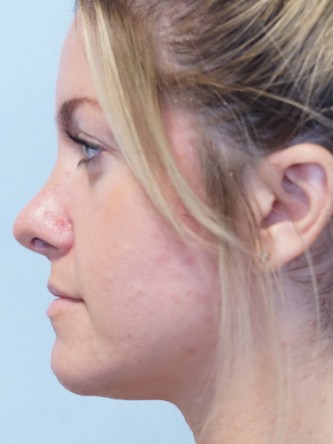 Boxy Tip Endonasal Rhinoplasty* — After