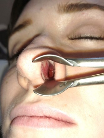 Nasal Profile Irregularity — Before