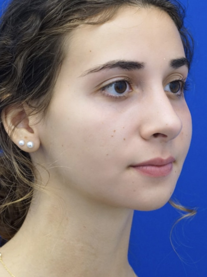 Classic Tension Nose — After