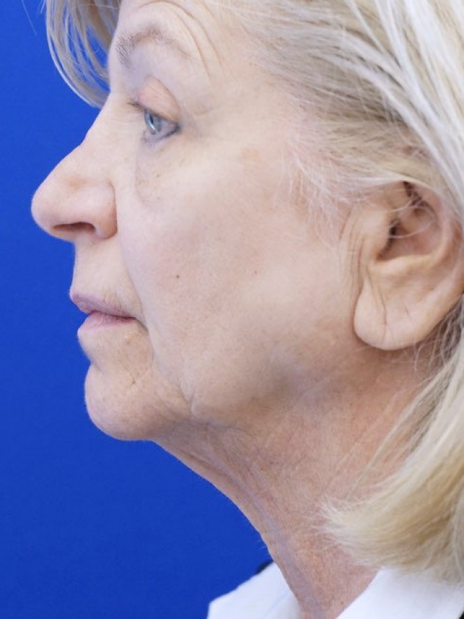 Jowls and Loose Neck Skin — Before