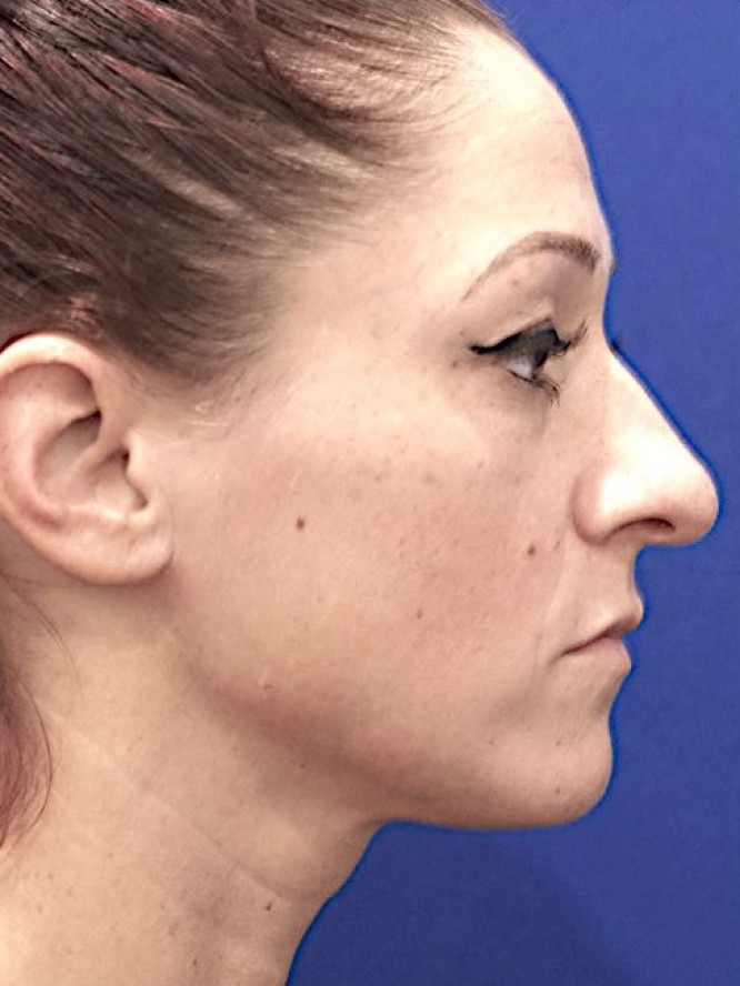 Dainty Nose — Before