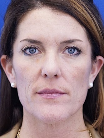 Upper Skin Only Blepharoplasty — Before