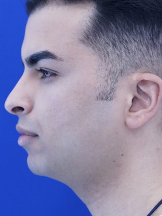 Vertical Lengthening Chin* — Before