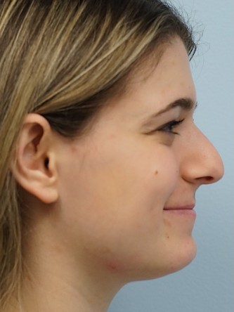 Droopy Tip Endonasal Rhinoplasty* — Before