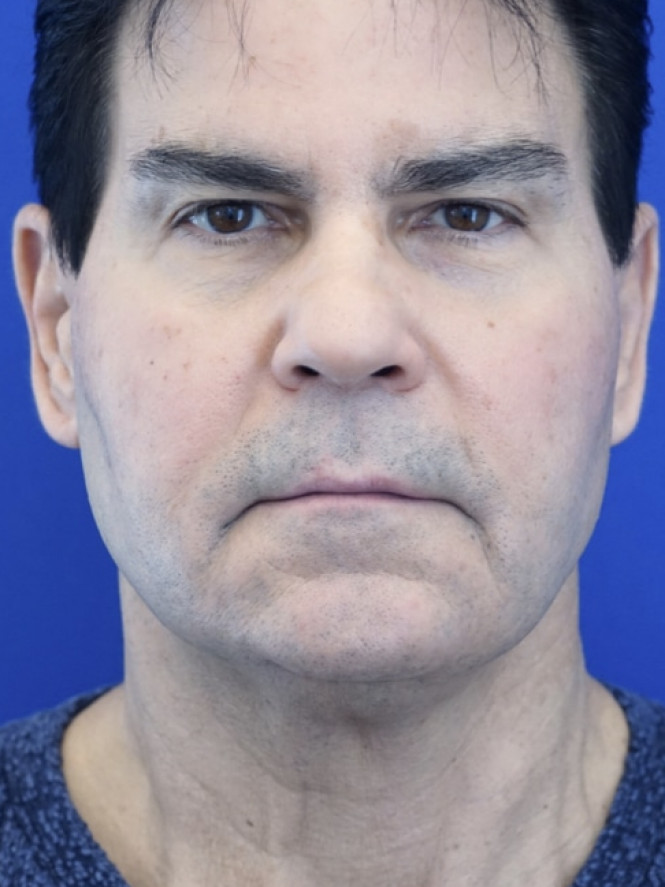 Male Facelift — Before