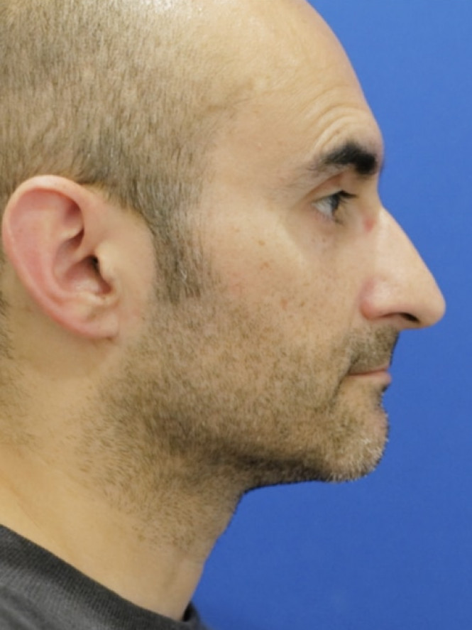 Tension Tip Ptosis — Before