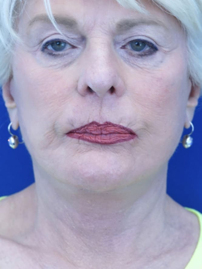 Deep Plane Lift and Platysmaplasty — After