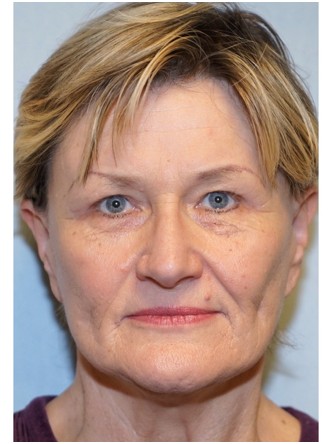 Endoscopic Browlift & Upper Eyelid Droop* — After