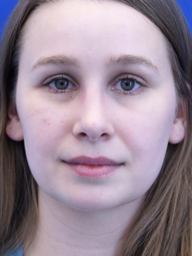 Facial Profile Plasty — After