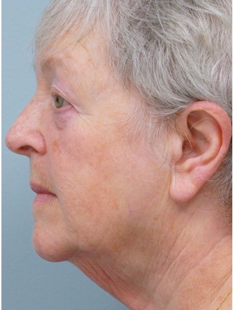 Aging Eyelid, Facelift, Necklift, Fractional CO2 Laser Resurfacing* — Before