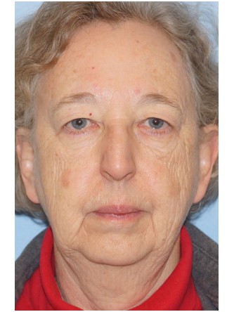 Visual Field Deficit – Eyelid Excess Skin3* — Before