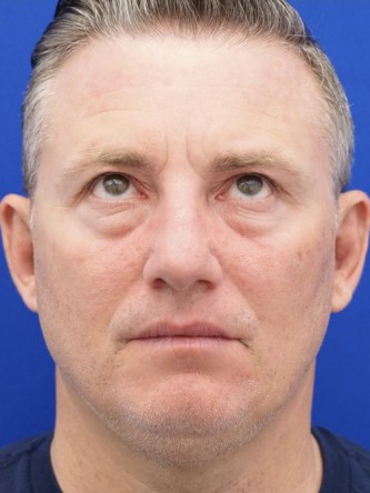 Lower Eyelid Fat Reposition — Before