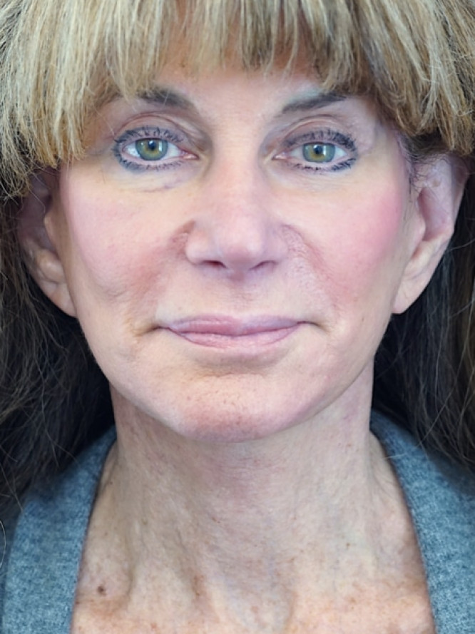 Deep Plane Midface Lift — After
