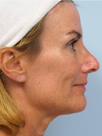 Voluma to Malar Cheek* — After