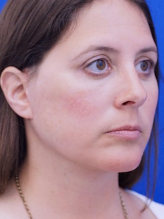 Facelift, Eyelid Lift, and Chin Liposuction* — After