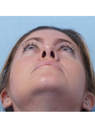 Boxy Tip Endonasal Rhinoplasty* — After
