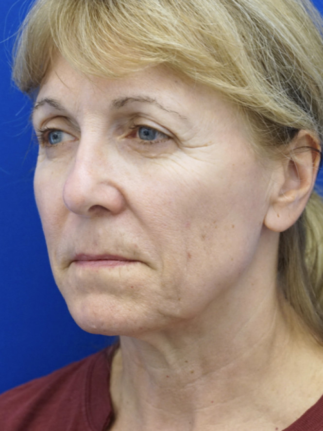 Hairline Browlift — Before