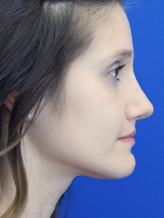 Nasal Profile Bliss — After
