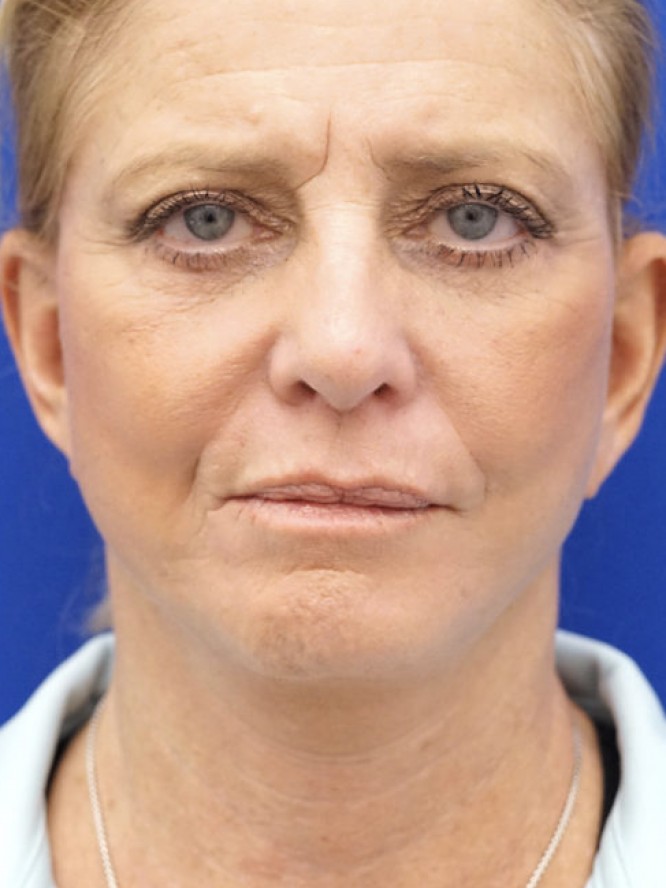 Deep Plane Lower Facelift — After