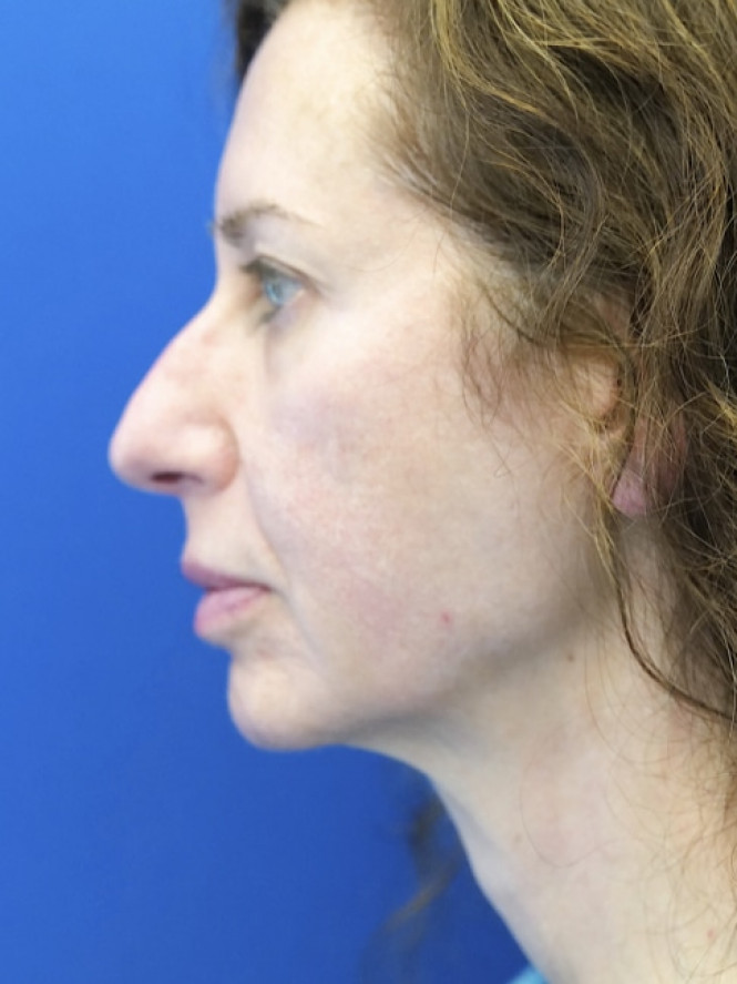 Natural Result — Before