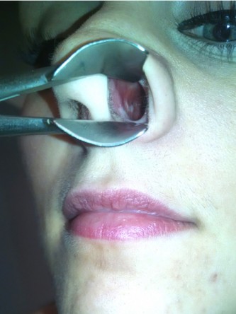 Nasal Septal Perforation1* — After