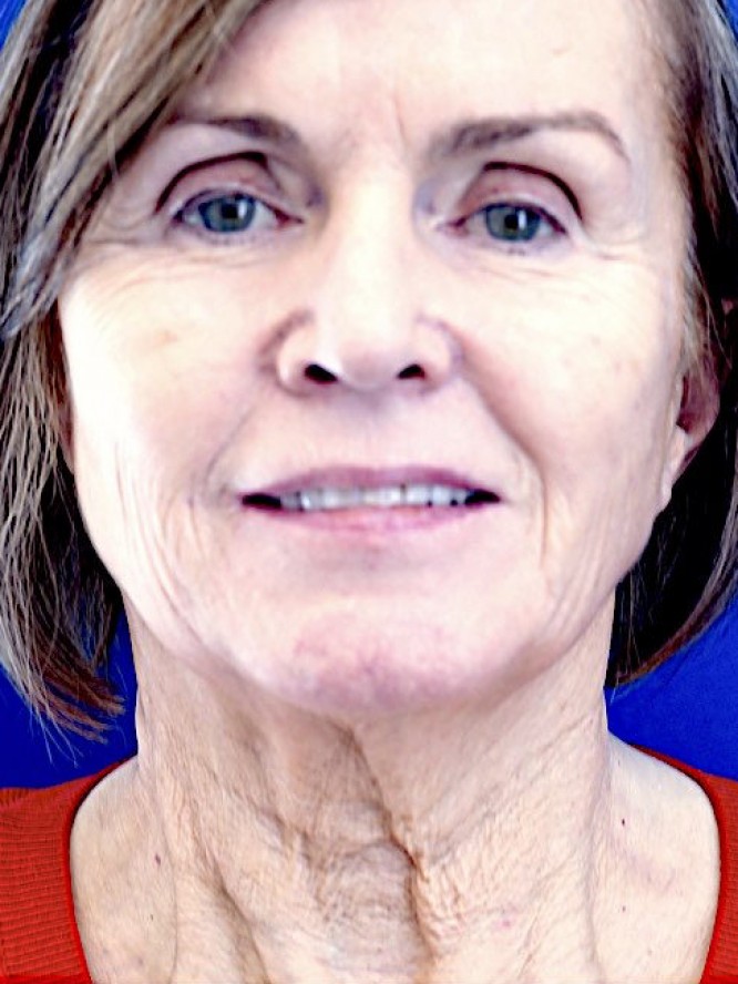 Deep Plane Lift and Fat Grafting — Before