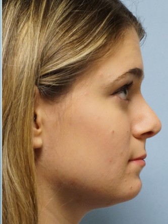 Droopy Tip Endonasal Rhinoplasty* — After