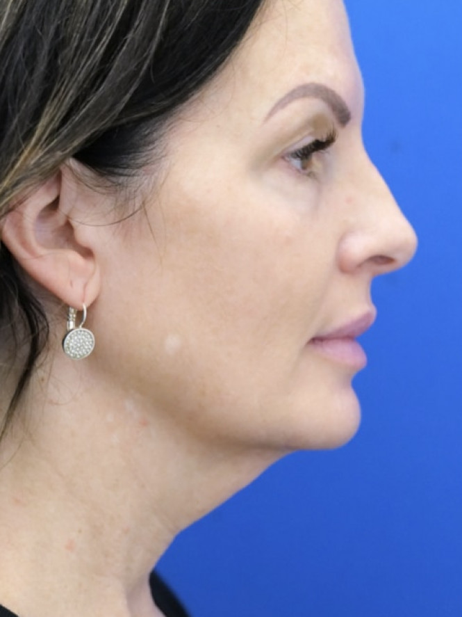 Deep Plane Cheek and Facelift — Before