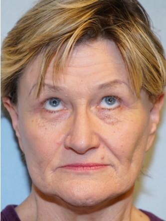 Endoscopic Browlift & Upper Eyelid Droop* — After