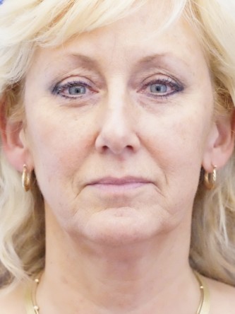 Facelift, Eyelid Skin Trim, Facial Fat Transfer* — Before