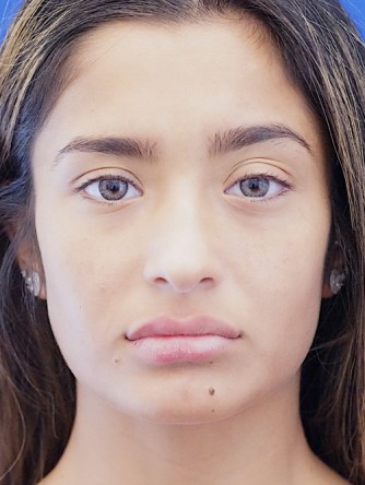 Voluptuous Lip Enhancement* — After