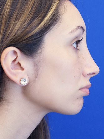 Nasal Profile Aesthetics — After