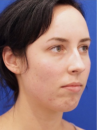 Chin Implant and Upper Lip Filler* — Before
