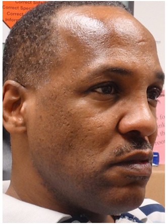 Saddle Nose – Repair Using Rib Cartilage* — After