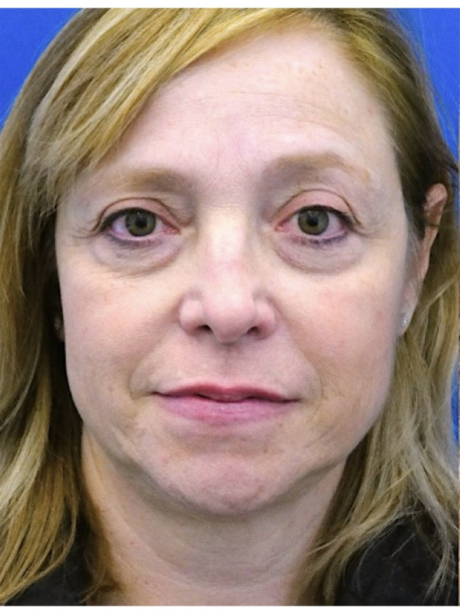 Upper and Lower Blepharoplasty — Before