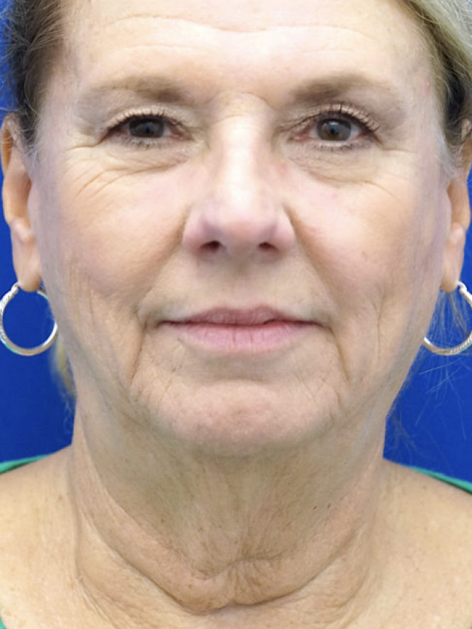 Lower Facial Aging and Fullness — Before