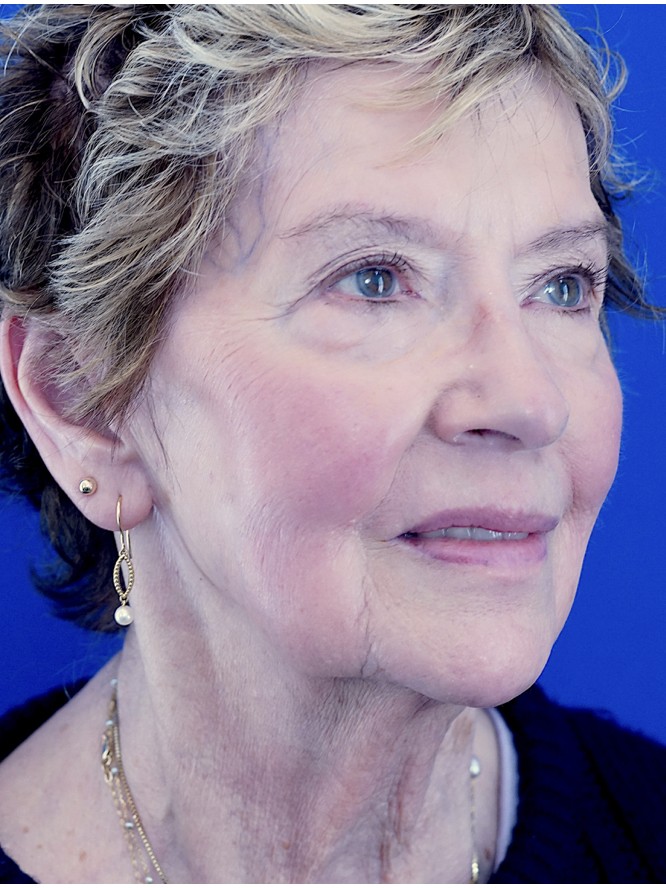 Deep Plane Facial Rejuvenation — Before