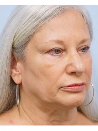 Over Projected Thick Skin Nose* — After
