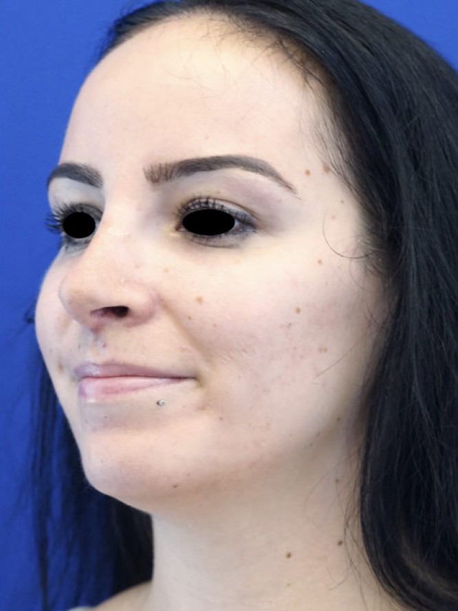 Nasal Tip Refinement — After