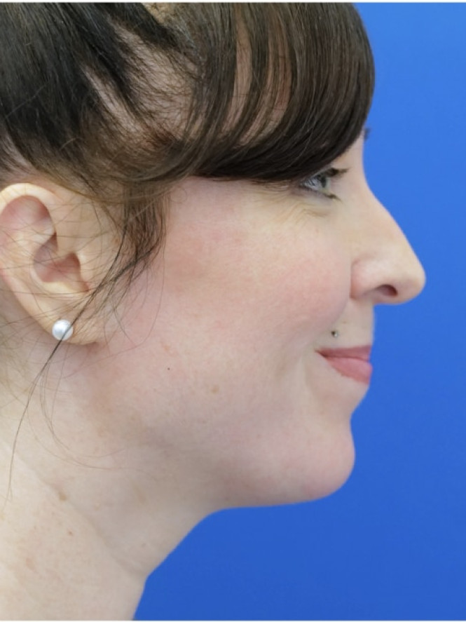 Dorsal Preservation and Refinement — Before