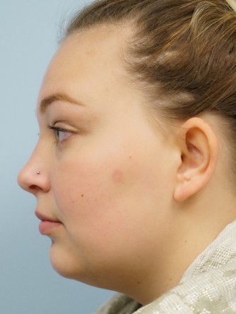 Restylane Silk Achieves Voluptuous Lips* — Before
