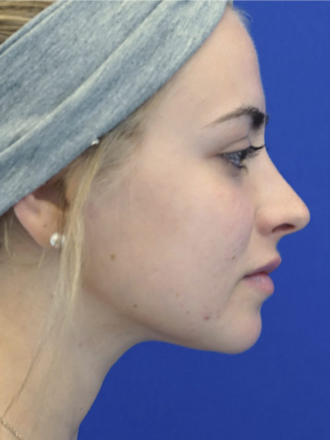 Smooth Dorsal Contour — After