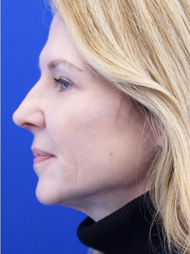 Alar Retraction and Boxy Tip — After