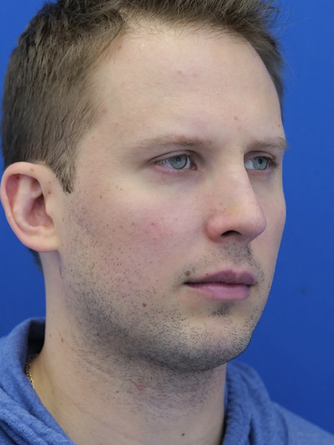 Dorsal Hump and Chin Augmentation — After
