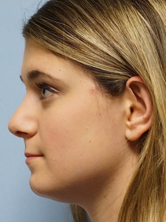 Droopy Tip Endonasal Rhinoplasty* — After