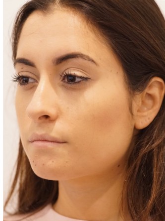 Restylane Silk to Volumize Lower Lip* — Before