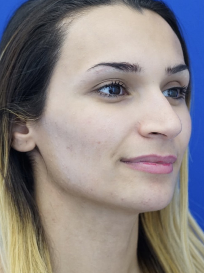 Nasal Deviation and Dainty Tip — Before