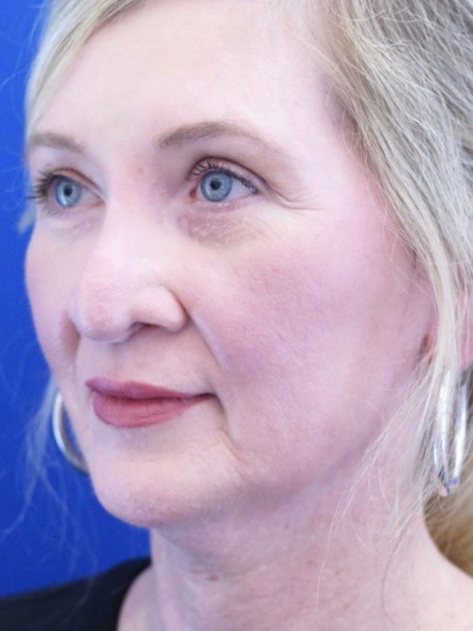 Thick Skin Droopy Nose — Before