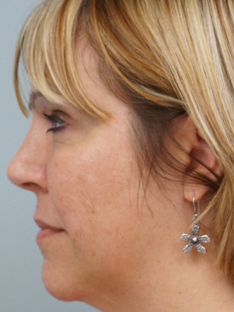 Cheek Augmentation using Voluma* — After